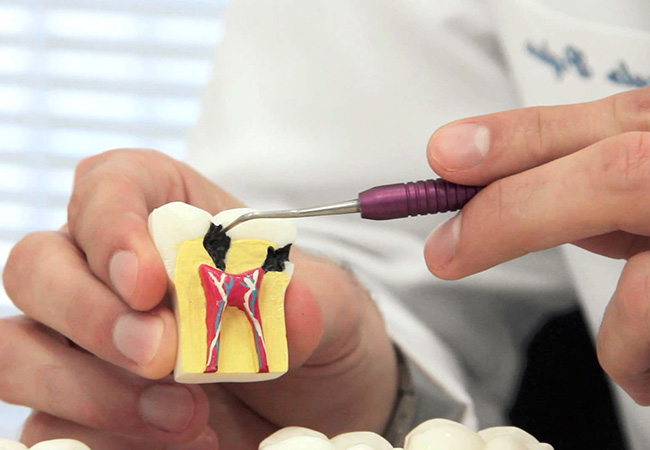 Показания к лечению зубов под микроскопом